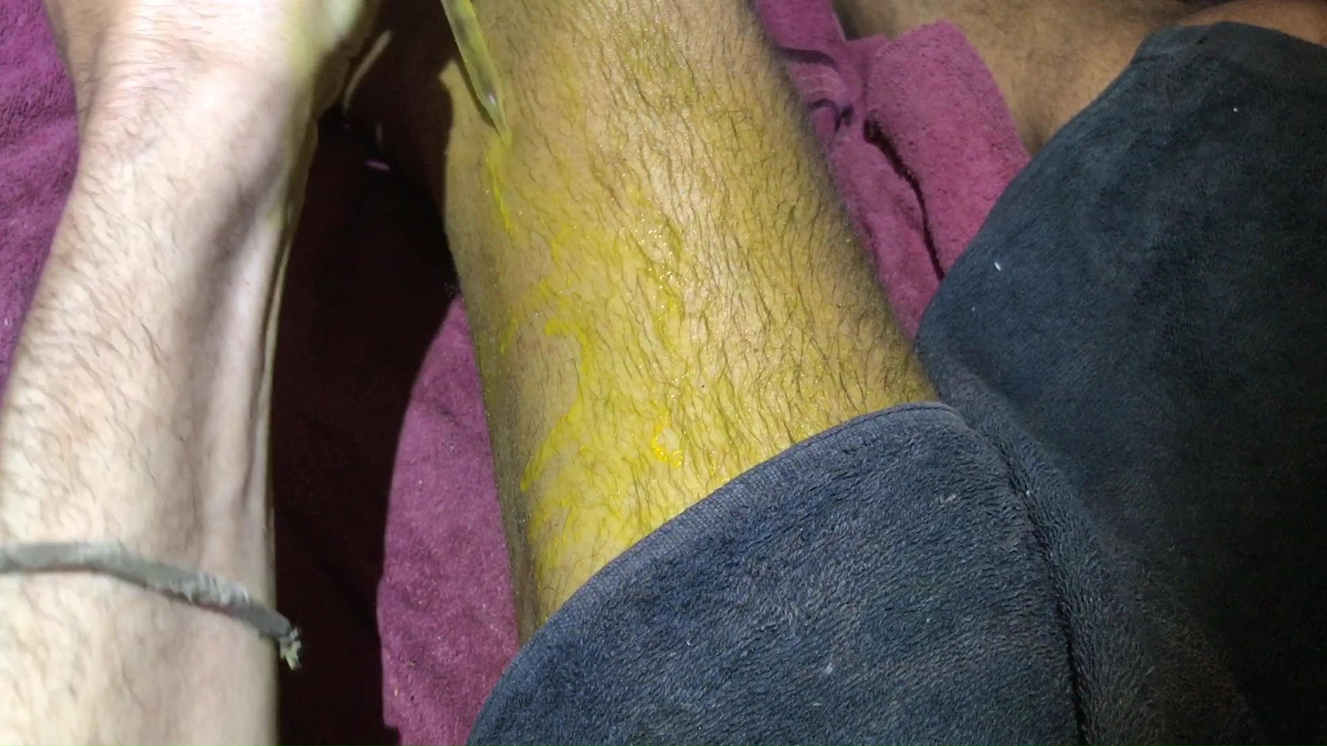 02 Apply in Turmeric Juice On Compartment Syndrome Bruise